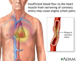 Angina Pectoris Management And Nursing Care Plan Nursing Path