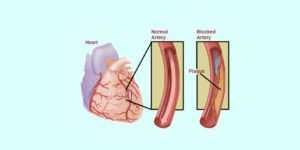 Angina Pectoris Nursing Care Plan & Management - RNpedia