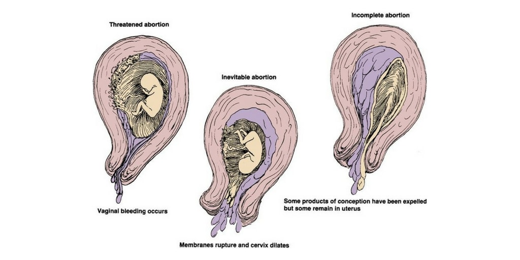 Spontaneous Abortion Nursing Management RNpedia