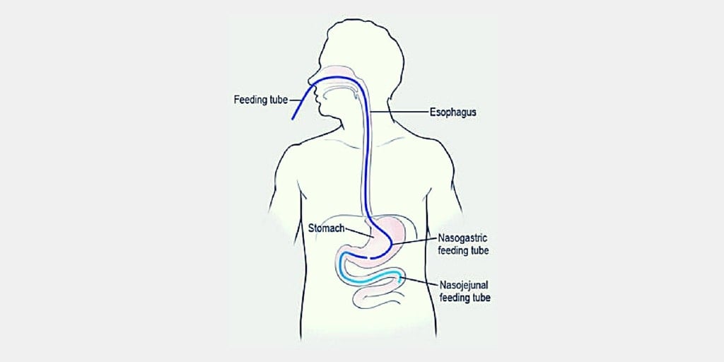 Tube Feeding RNpedia