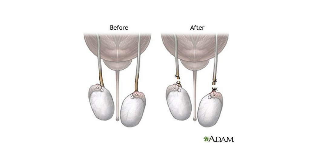 vasectomy-rnpedia