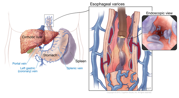 nursing case study esophageal varices
