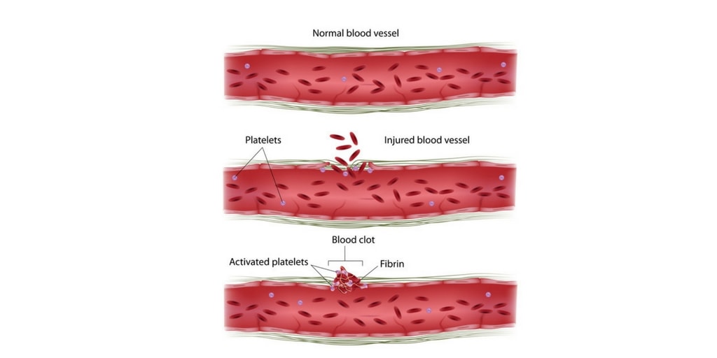 parahemophilia-factor-v-deficiency-nursing-management-rnpedia