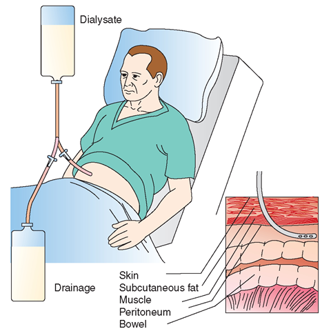 Dialysis Nursing Care Plan & Management - RNpedia