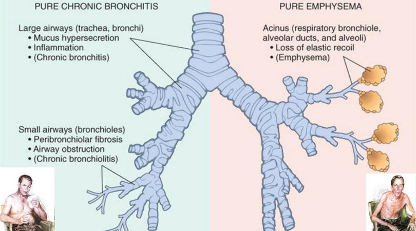 acute-bronchitis-what-is-acute-bronchitis