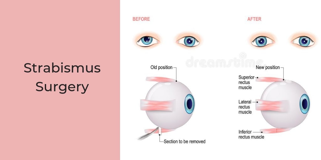 Strabismus Nursing Management - RNpedia