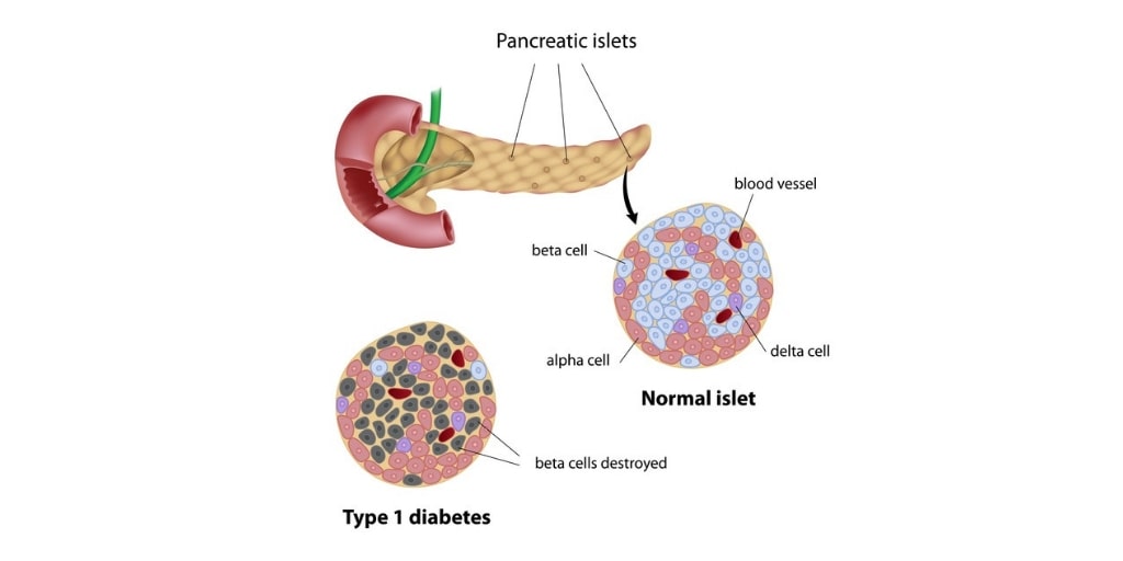 Diabetes Symptoms And Causes Mayo Clinic